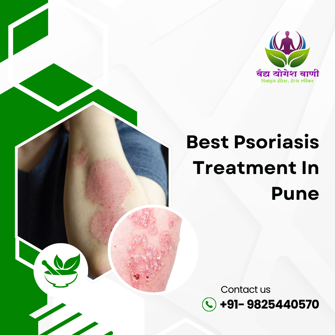 Why Vaidya Yogesh Vani Offers the Best Psoriasis Treatment in Pune